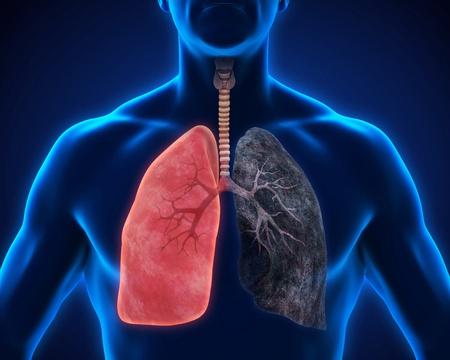 慢性阻塞性肺疾病稳定期患者的肺康复