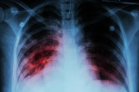 西地那非可以治疗慢性阻塞性肺疾病相关肺动脉高压吗？