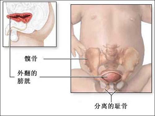 关于膀胱外翻外科手术治疗的一些临床总结