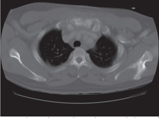 临床分享一种极为罕见的肺外结核--原发性胸骨结核合并骨髓炎