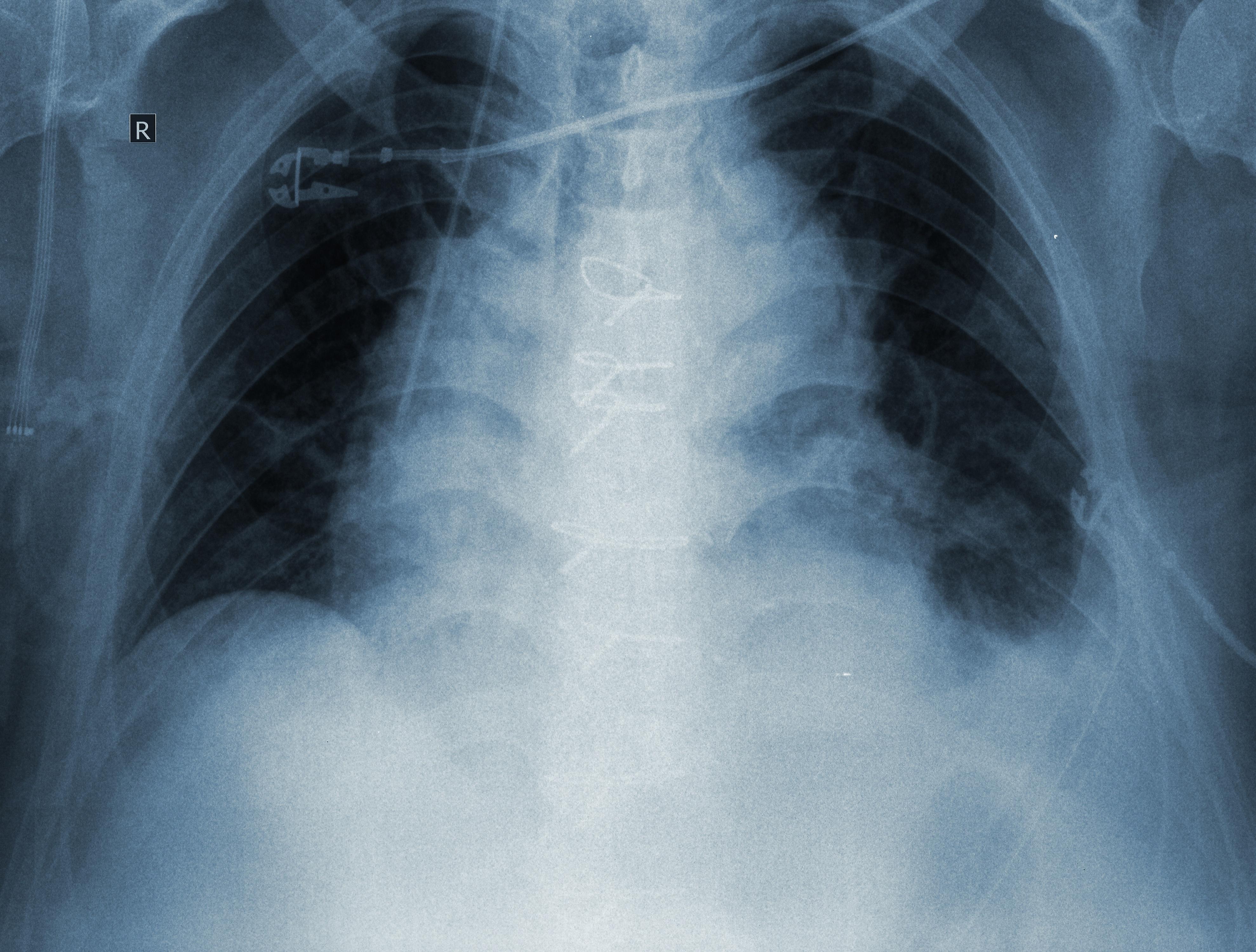 慢性支气管炎X线图片