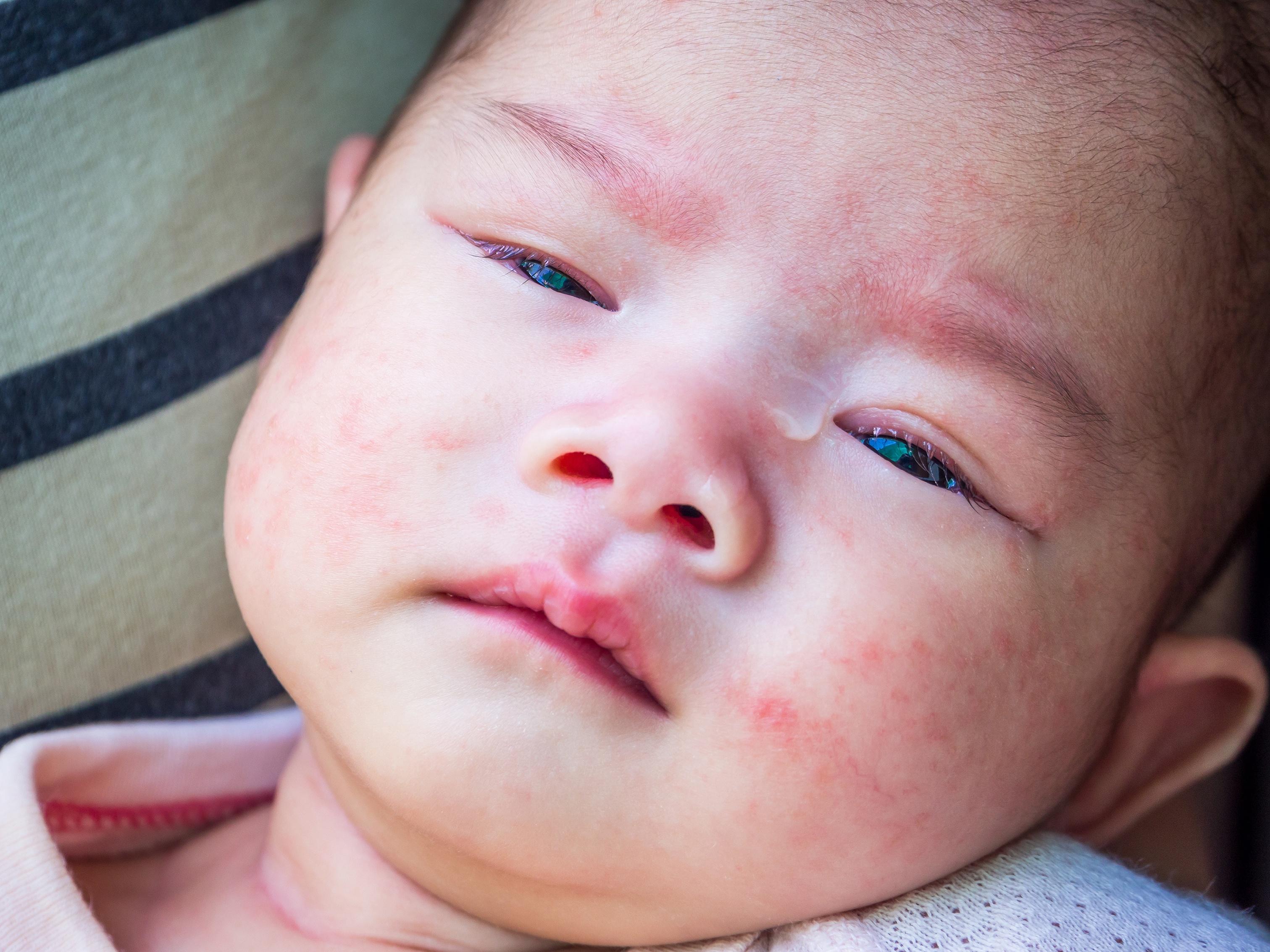 婴儿湿疹的诊断治疗研究进展
