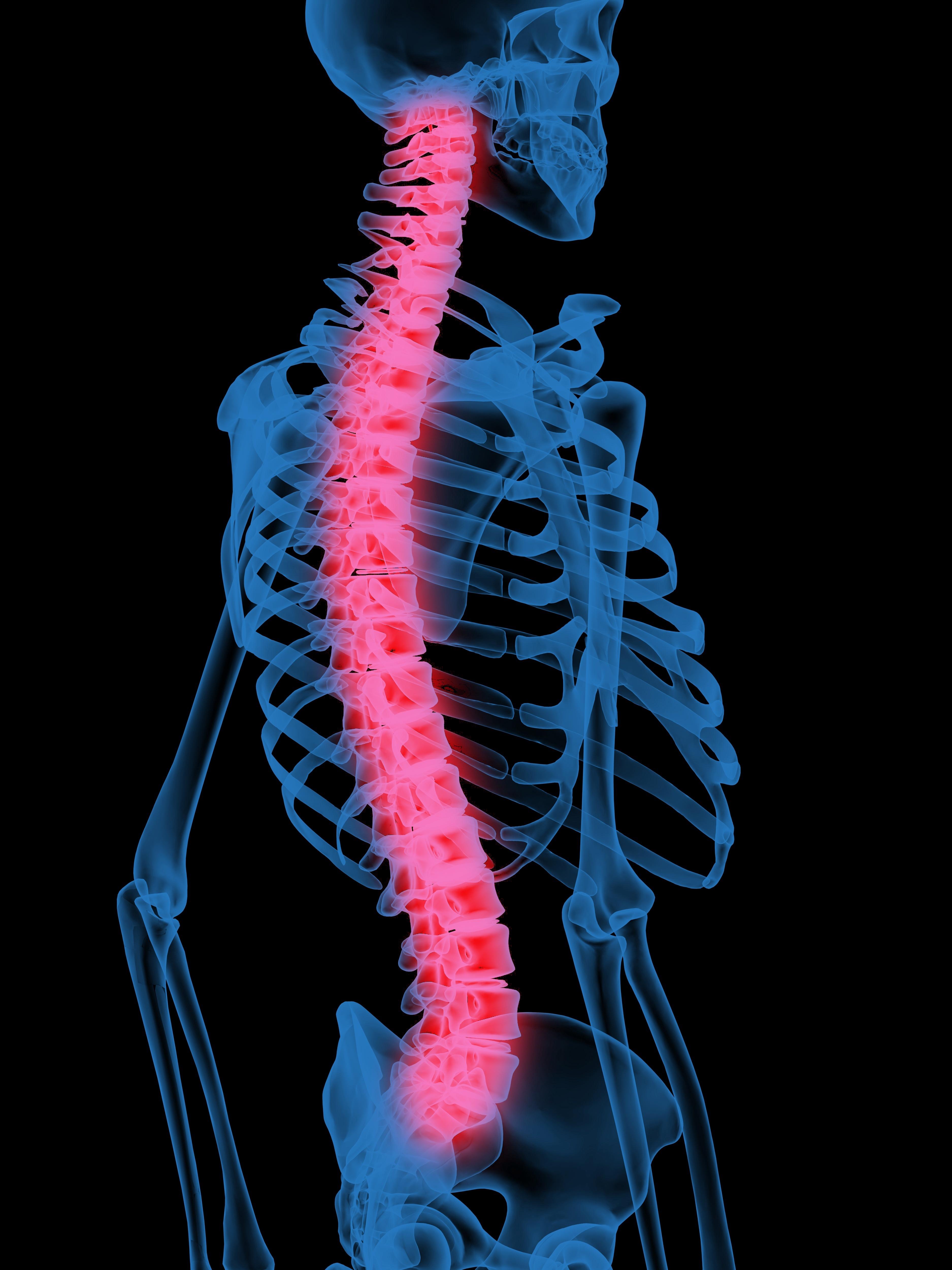 脊柱腫瘤與脊柱結核的誤診分析