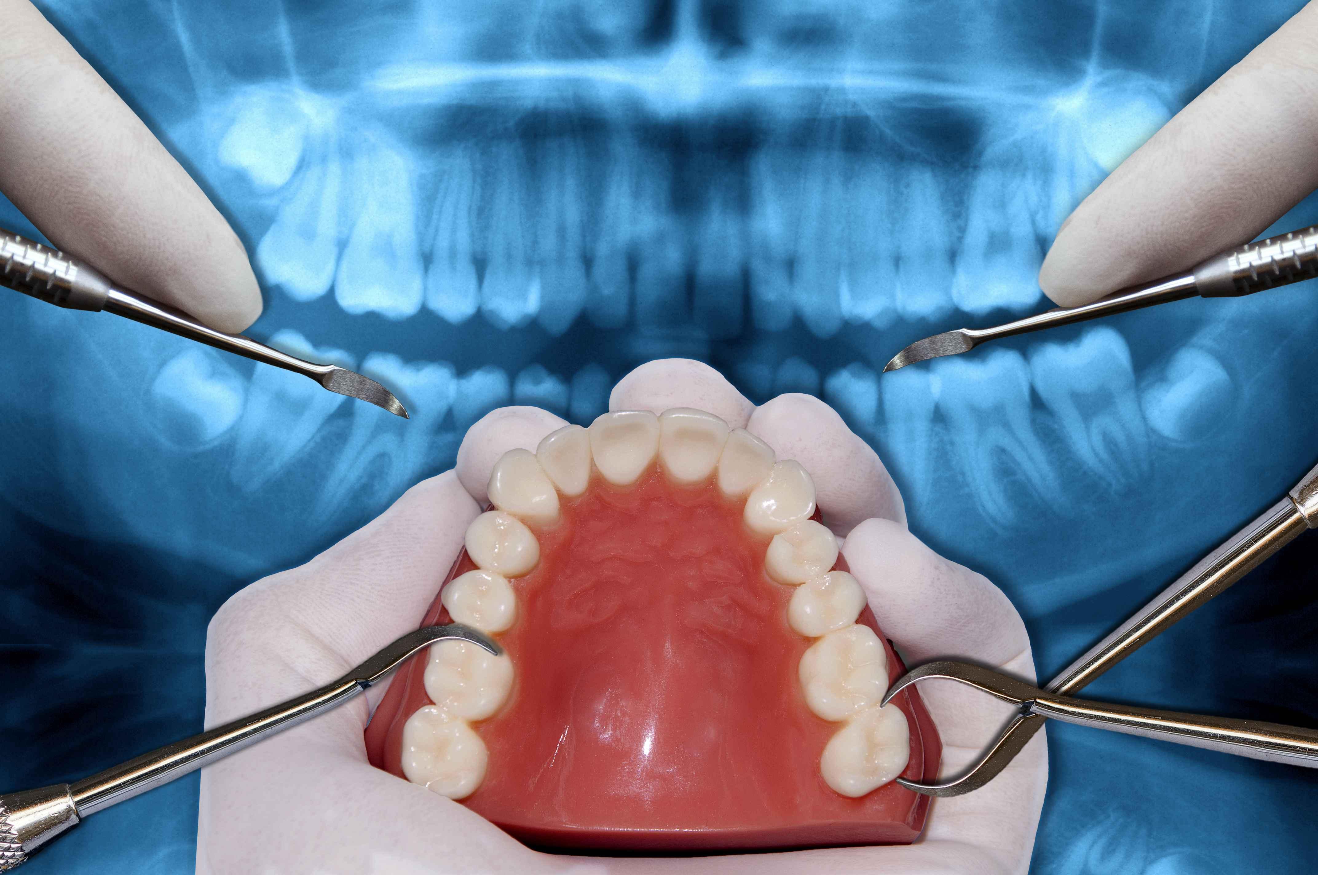 下颌矢状劈开术导致的舌神经和下牙槽神经损伤治疗