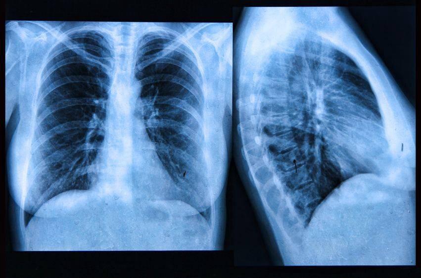 哮喘x线图片图片
