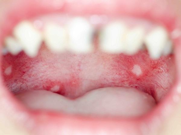 白塞病的口腔溃疡图片图片